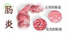 福州哪家肛肠医院治肛瘘好？